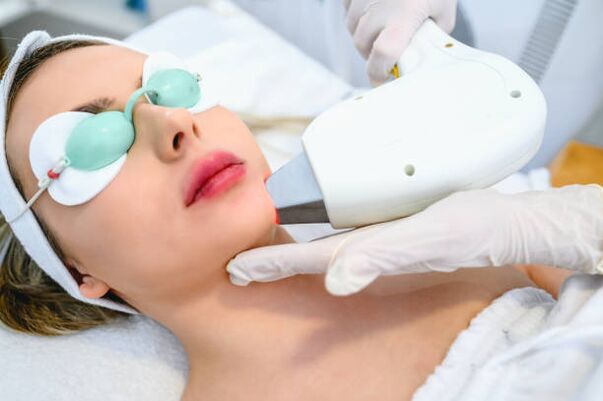 Procedemento láser para o rexuvenecemento da pel facial