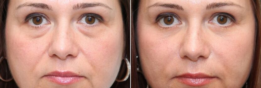 Antes e despois da blefaroplastia - eliminación do corpo de graxa baixo os ollos e endurecemento da pel