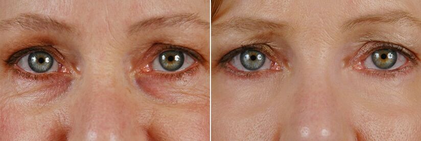 Antes e despois da cirurxía con láser - rexuvenecemento da pel arredor dos ollos